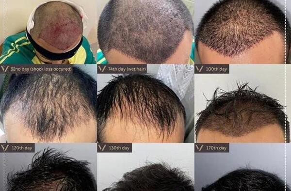 عکس کاشت مو بعد از 3 ماه