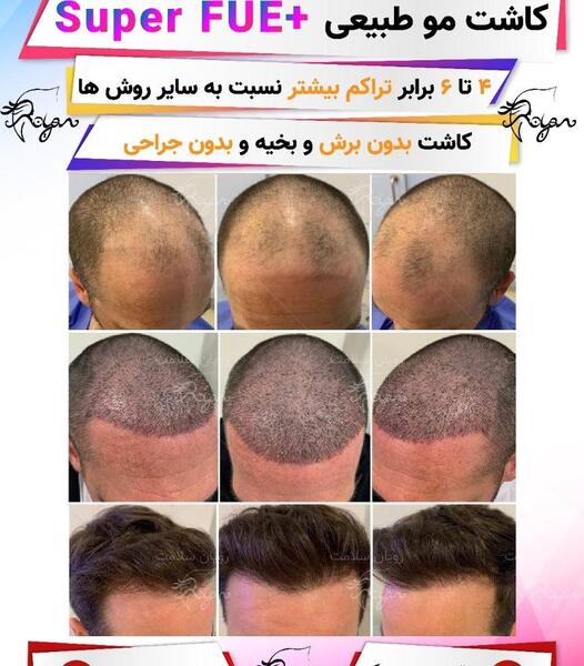 عکس کاشت مو بعد از 3 ماه