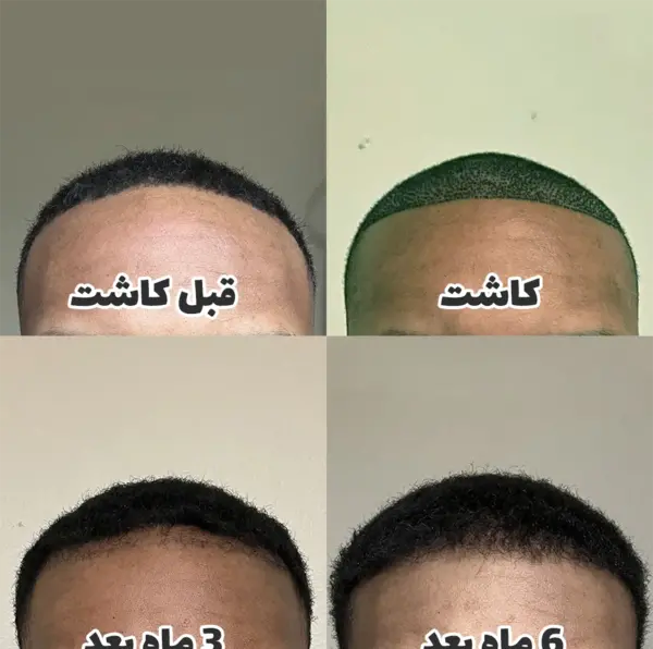 عکس کاشت مو بعد دو ماه