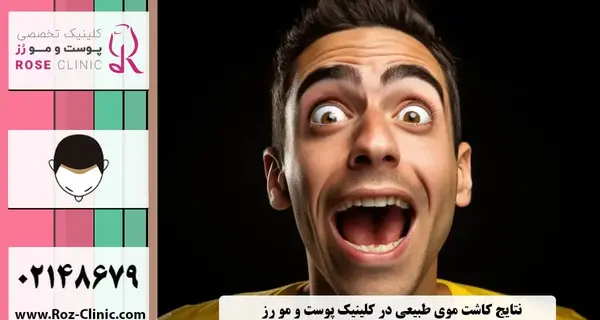 عکس کاشت مو بعد سه ماه