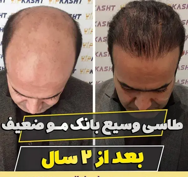 عکس کاشت مو بعد سه ماه