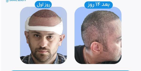 عکس کاشت مو بعد سه ماه