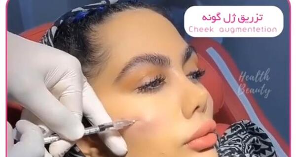 عکس کاشت گونه با ژل