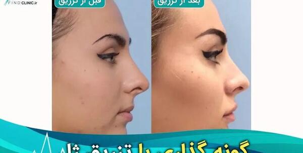 عکس کاشت گونه با ژل