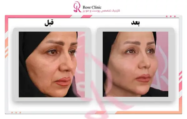 عکس کاشت گونه با ژل