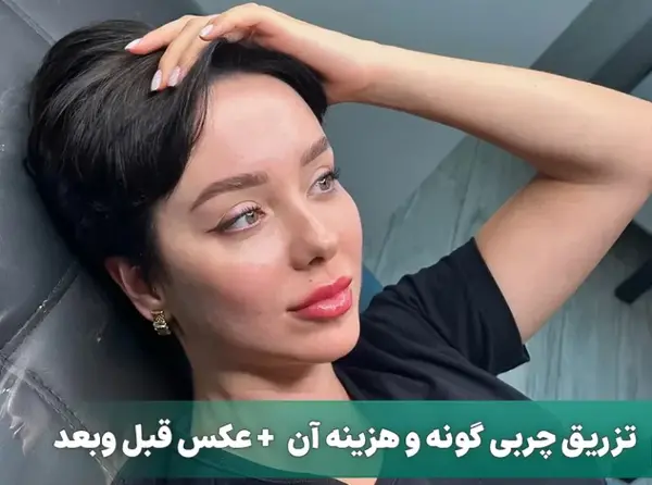 عکس کاشت گونه با ژل