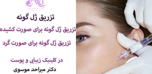 عکس کاشت گونه با ژل