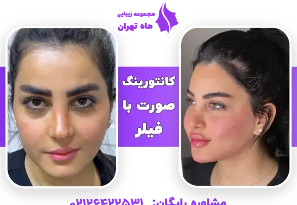 عکس کاشت گونه با ژل