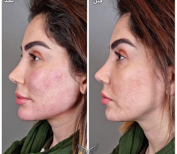 عکس کاشت گونه با ژل