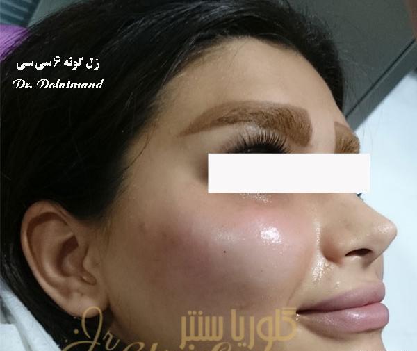 عکس کاشت گونه با ژل