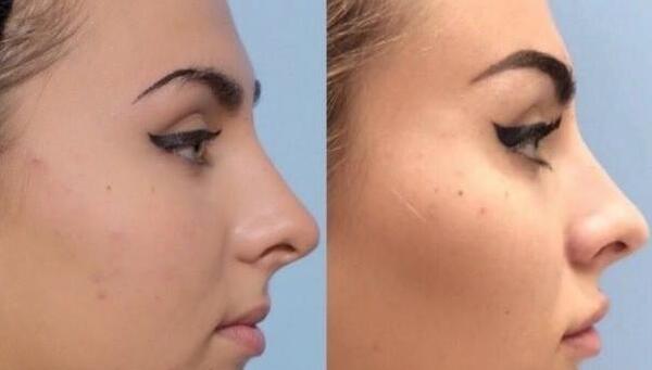 عکس کاشت گونه با ژل