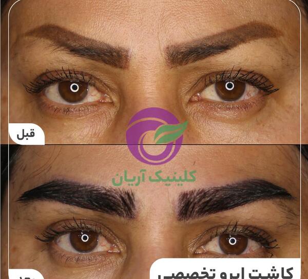 عکس ابرو کاشته شده