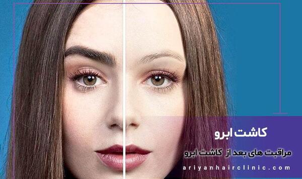 عکس ابرو کاشته شده