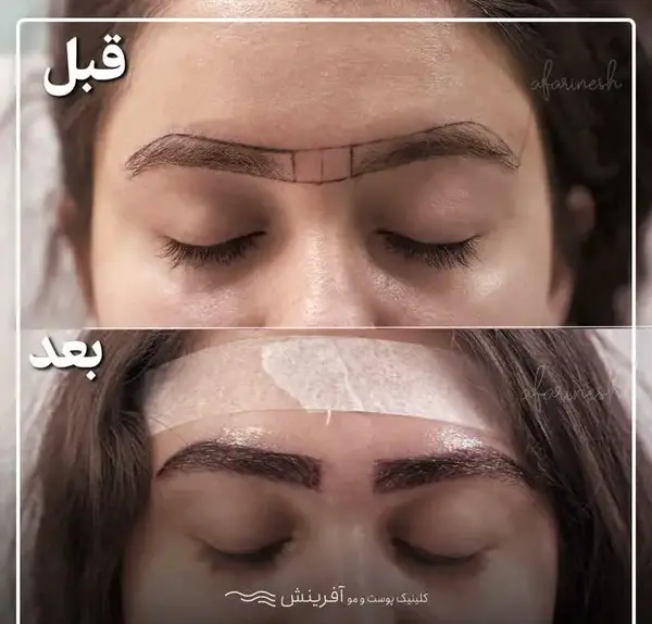 عکس ابرو کاشته شده