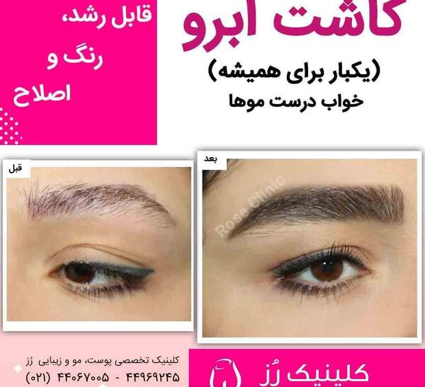 عکس ابرو کاشته شده