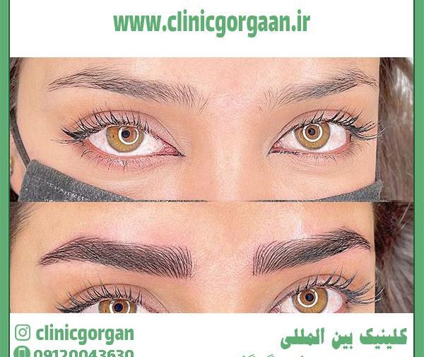 عکس ابرو کاشته شده
