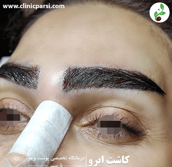 عکس ابرو کاشته شده