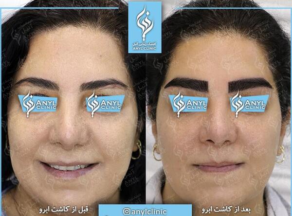 عکس ابرو کاشته شده