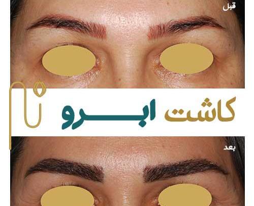 عکس قبل و بعد از کاشت ابرو