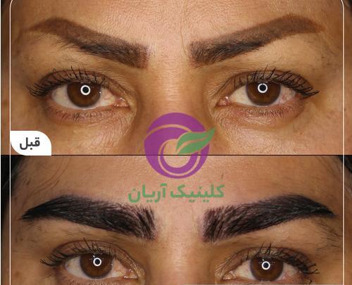 عکس قبل و بعد از کاشت ابرو