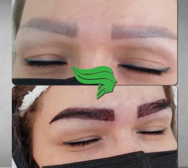 عکس قبل و بعد از کاشت ابرو