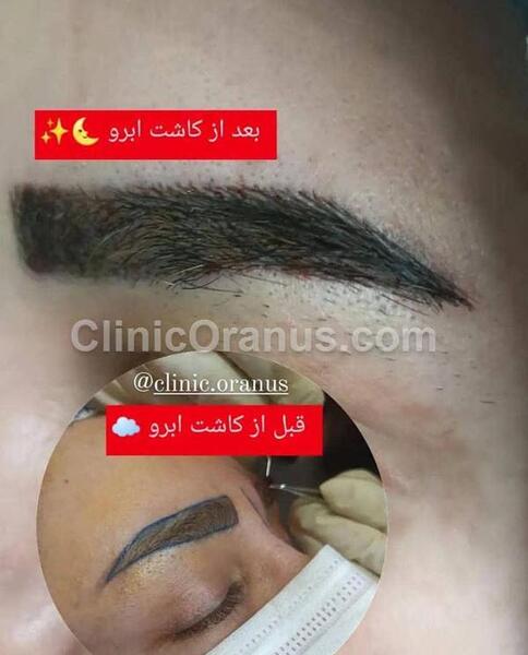 عکس قبل و بعد از کاشت ابرو