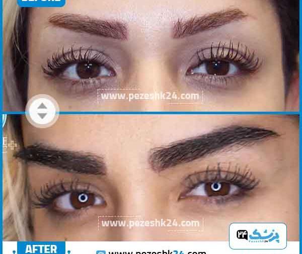 عکس قبل و بعد از کاشت ابرو