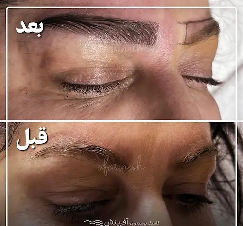 عکس قبل و بعد از کاشت ابرو