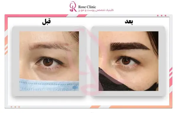 عکس قبل و بعد از کاشت ابرو