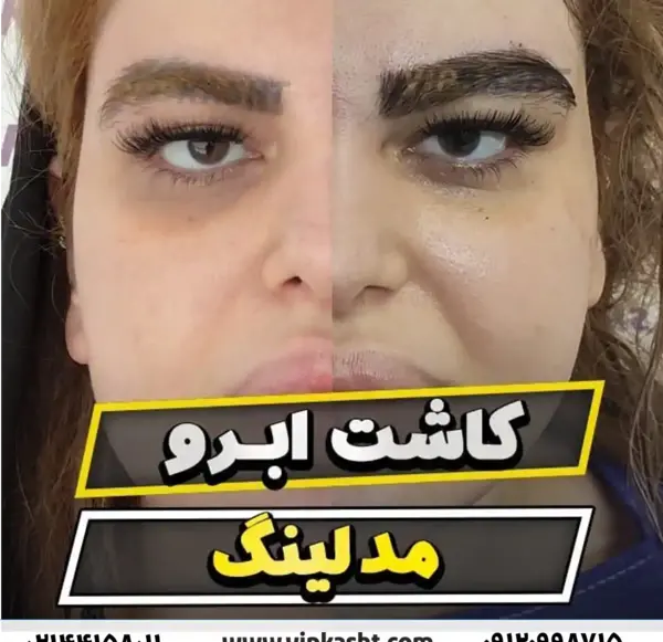 عکس قبل و بعد از کاشت ابرو