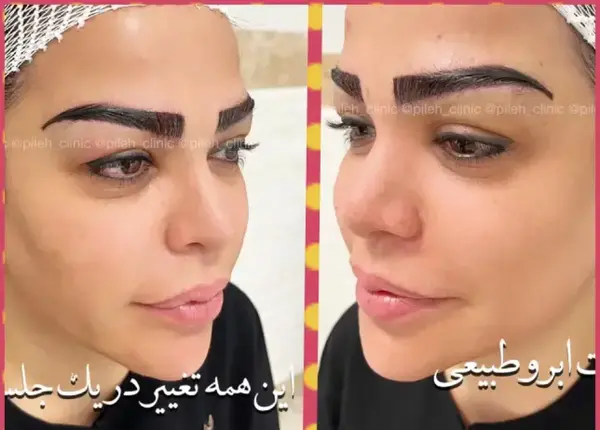 عکس قبل و بعد از کاشت ابرو