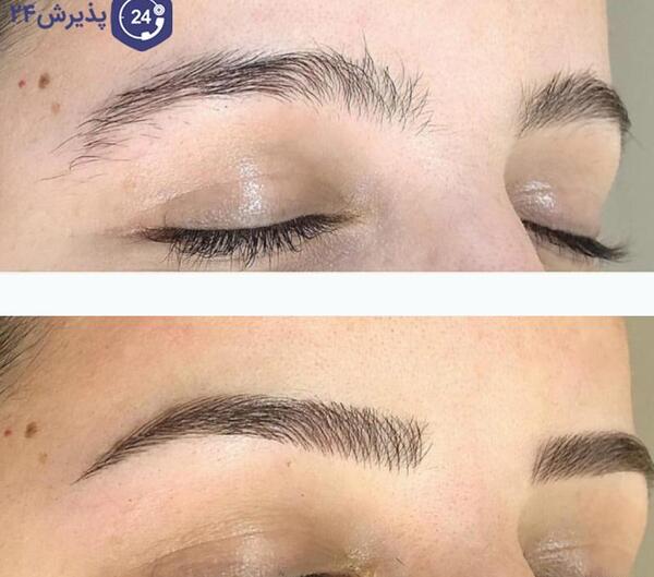 عکس قبل و بعد از کاشت ابرو