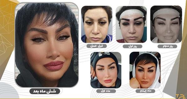 عکس قبل و بعد از کاشت ابرو