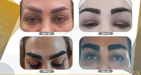 عکس قبل و بعد از کاشت ابرو