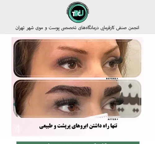 عکس قبل و بعد از کاشت ابرو