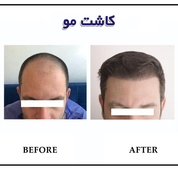 عکس های کاشت مو قبل و بعد