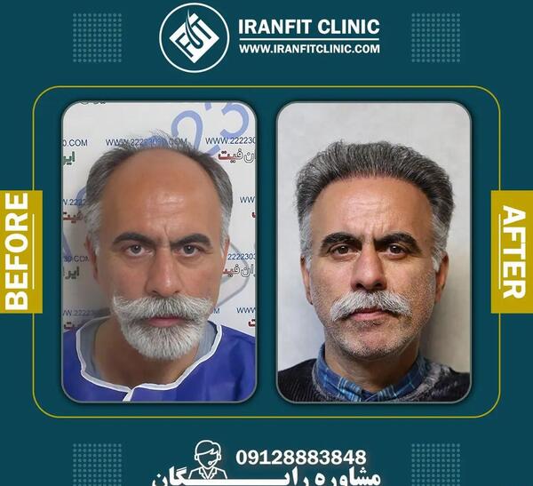 عکس های کاشت مو قبل و بعد