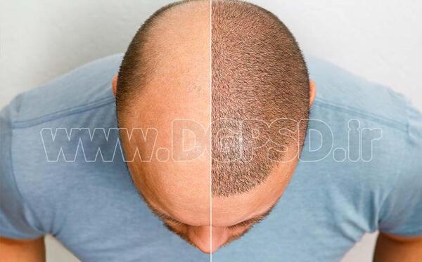 عکس های کاشت مو قبل و بعد