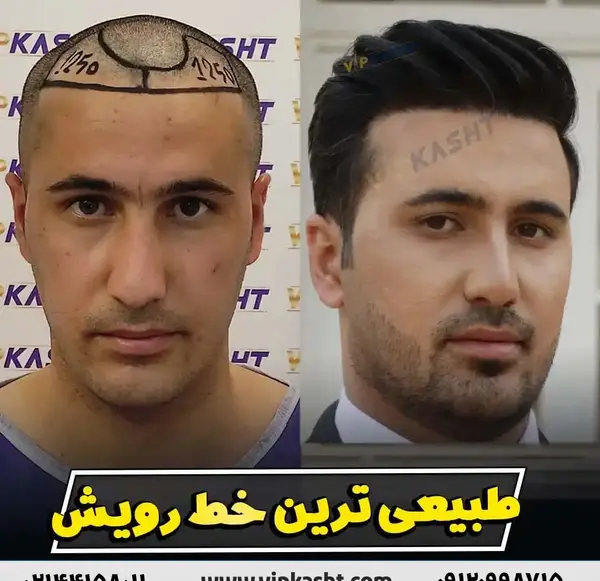عکس های کاشت مو قبل و بعد