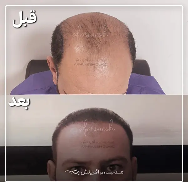 عکس های کاشت مو قبل و بعد