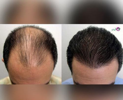 عکس های کاشت مو قبل و بعد