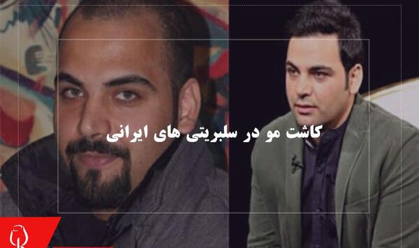 عکس قبل و بعد کاشت مو احسان علیخانی