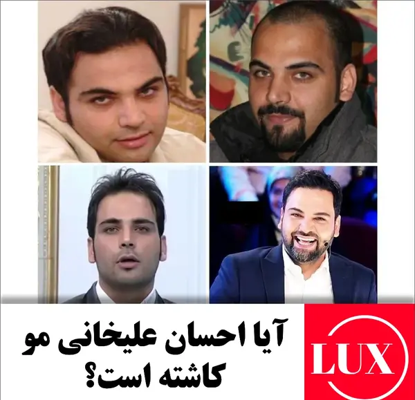 عکس قبل و بعد کاشت مو احسان علیخانی