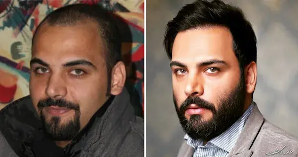 عکس قبل و بعد کاشت مو احسان علیخانی