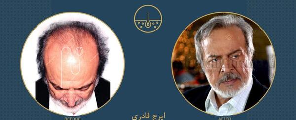 عکس قبل و بعد کاشت مو احسان علیخانی
