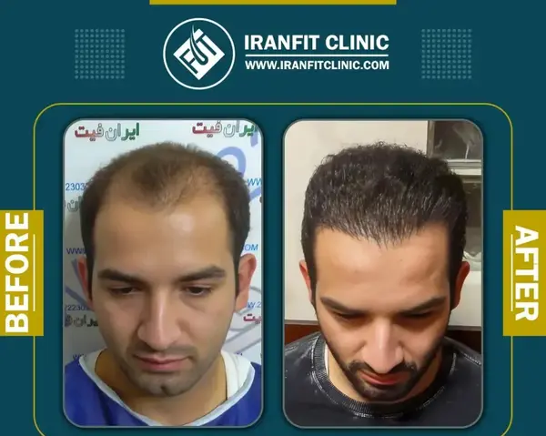 عکس قبل و بعد کاشت مو احسان علیخانی