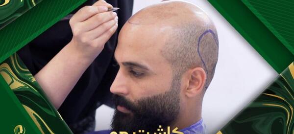 عکس قبل و بعد کاشت مو علی قلی زاده