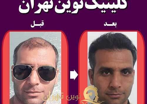 عکس قبل و بعد کاشت مو علی قلی زاده