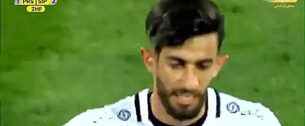 عکس قبل و بعد کاشت مو علی قلی زاده