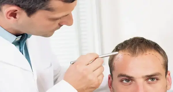 عکس قبل و بعد کاشت مو علی قلی زاده